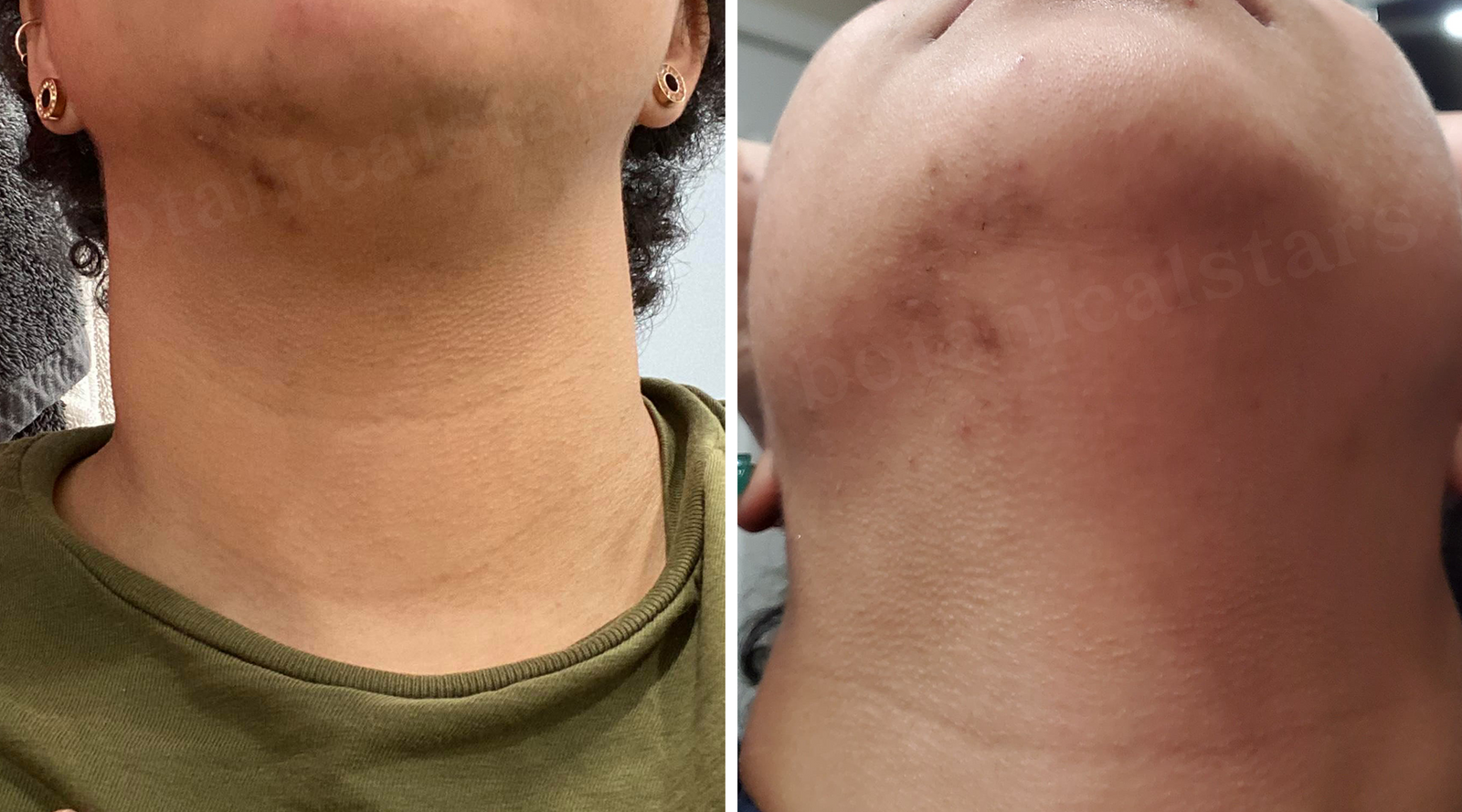 Clearing Persistent Hormonal Acne and Scarring With One Gentle Product