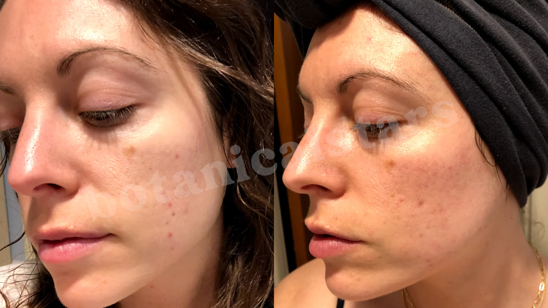 Erasing Scarring Formed Years Ago & Toning Oily/Acne-Prone Skin Easily